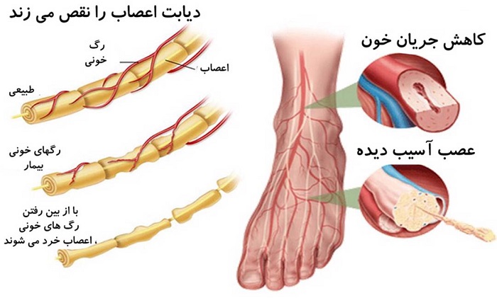 بیماری نوروپاتی و درمان آن