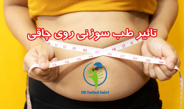 تاثیر طب سوزنی روی چاقی