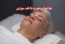 جوانسازی صورت با طب سوزنی